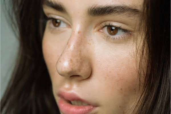 pigmentation